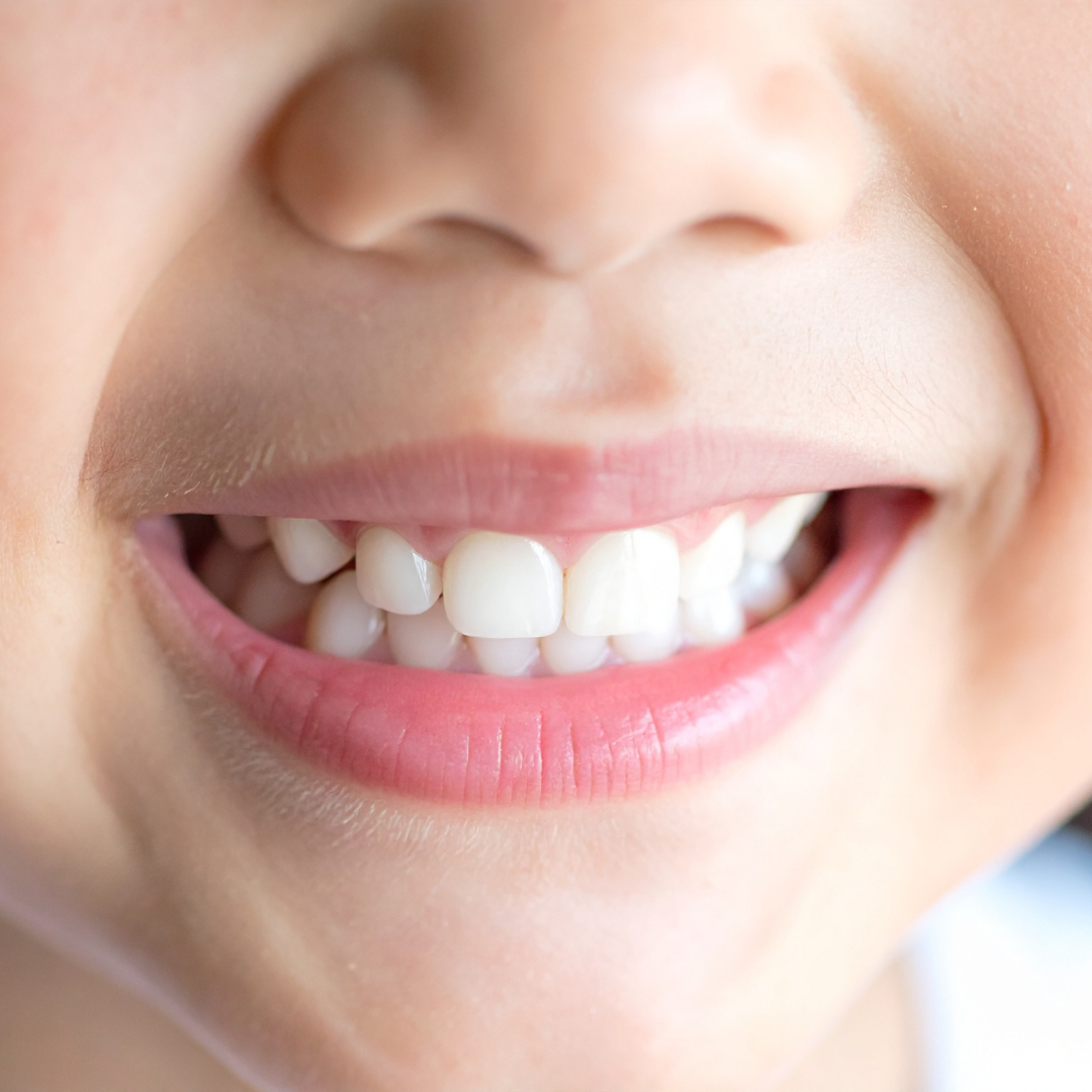 Gigi Susu Anak Berlubang? Jangan Disepelekan, Ini Dampaknya Menurut Dokter Gigi Anak Dentalife Surabaya