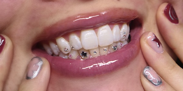 Tooth Gems Lagi Hits, Aman Nggak Sih untuk Gigi?