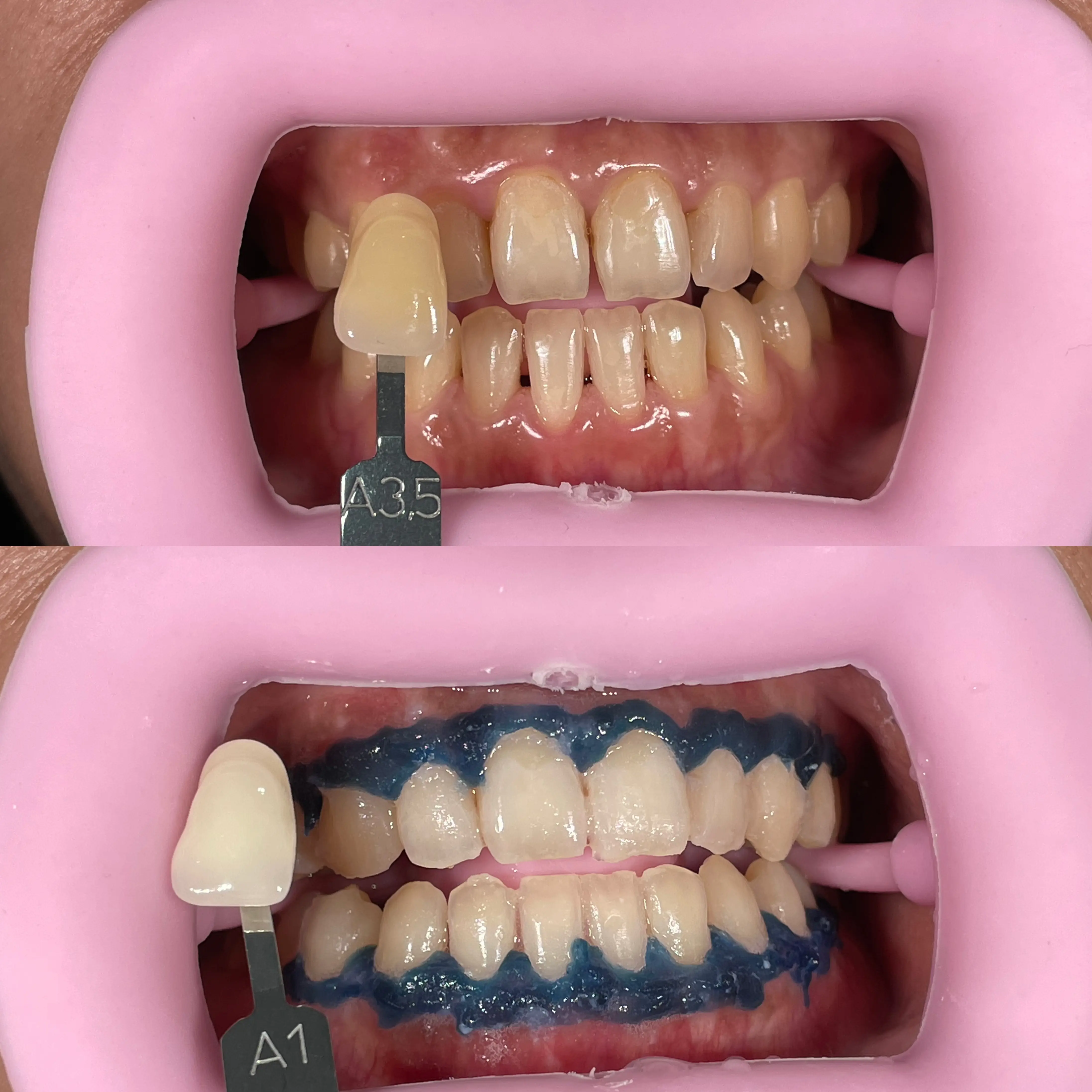 Bleaching / Teeth Whitening